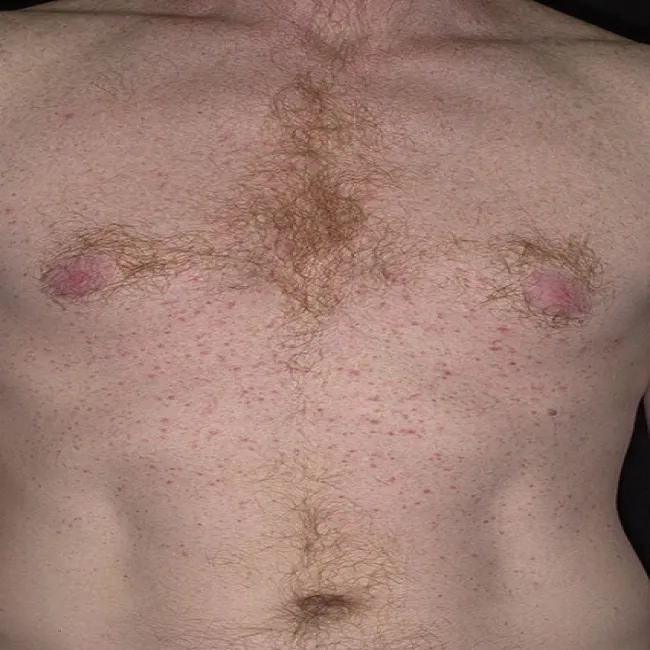 Czerwone kropki na ciele choroba Grovera