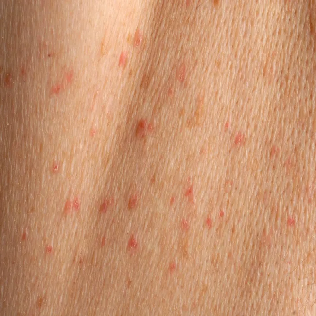 Czerwone krostki na skórze choroba Grovera