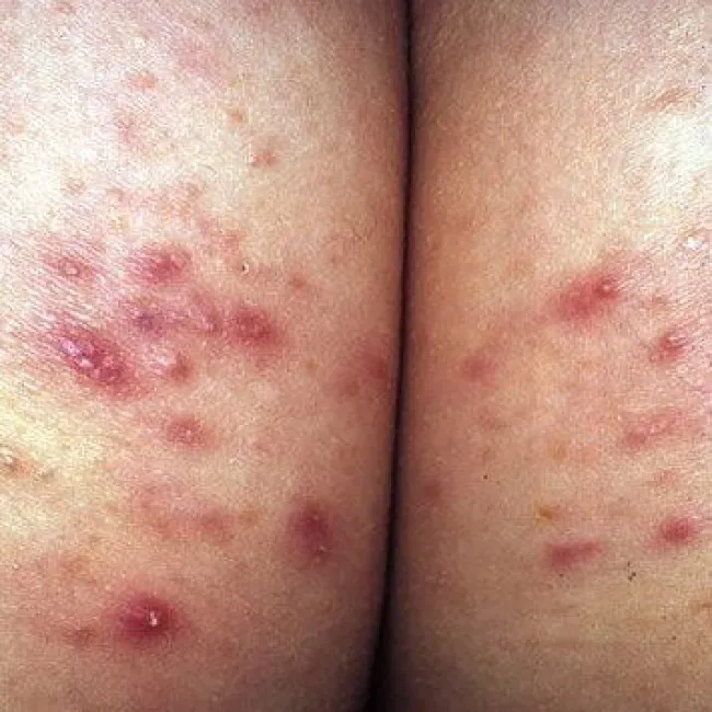 Czerwone krosty na pośladkach zapalenie mieszków włosowych