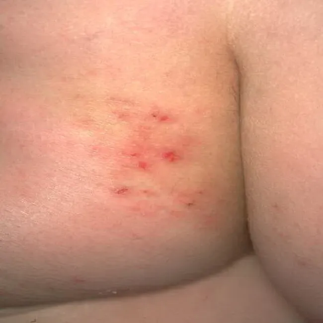 Czerwone krosty na pośladku opryszczkowate zapalenie skóry 