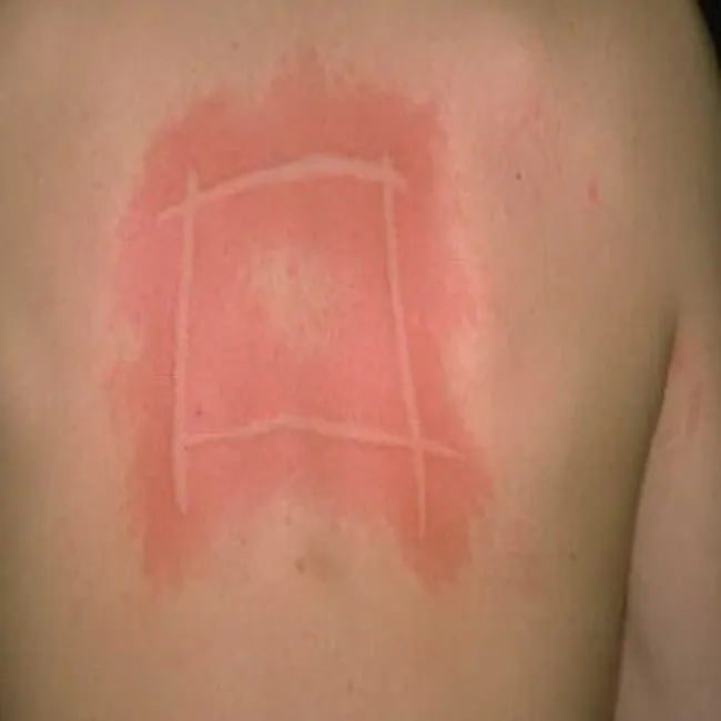 Czerwone linie na skórze