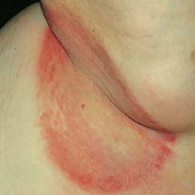 Czerwone plamy na ciele łupież rumieniowy