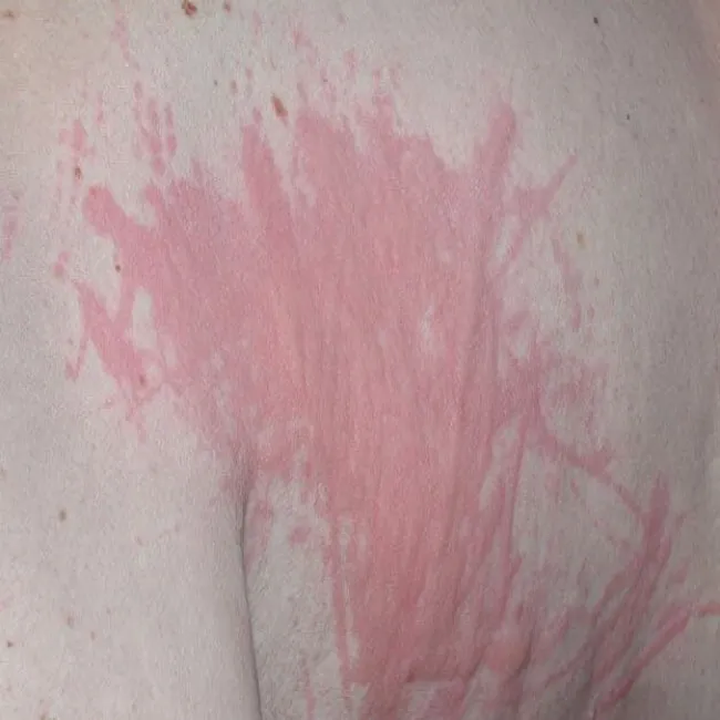 Czerwone plamy na ciele zdjęcia