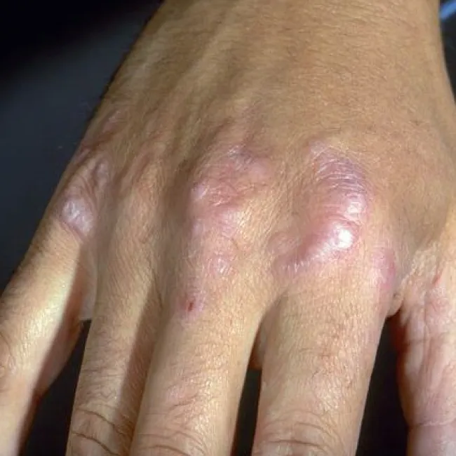 Czerwone plamy na dłoni choroba ziarniniak obrączkowaty 