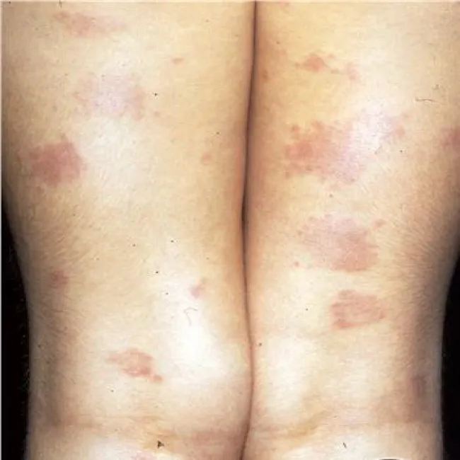 Czerwone plamy na nogach choroba ziarniniak obrączkowaty 