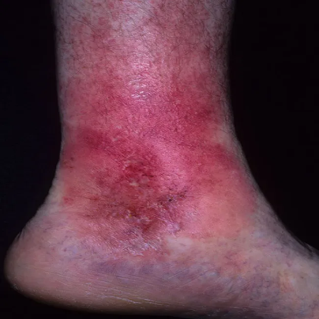 Czerwone plamy na nogach wyprysk podudzi