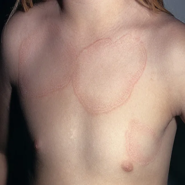 Czerwone plamy na skórze klatki piersiowej ziarniniak obrączkowaty 