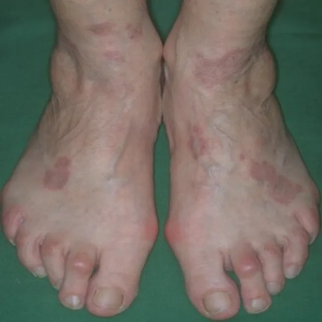 Czerwone plamy na stopach choroba ziarniniak obrączkowaty 