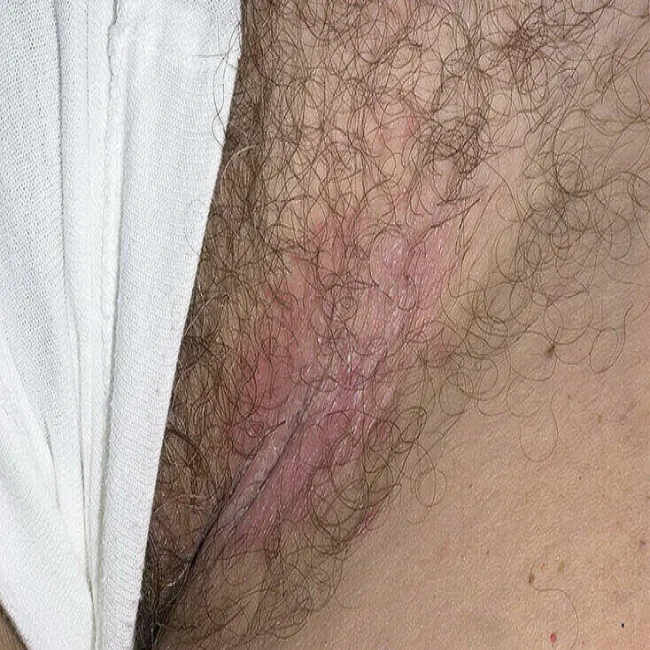 Czerwone plamy w okolicach intymnych u kobiet