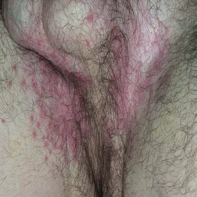 Czerwone plamy w okolicach intymnych u mężczyzn