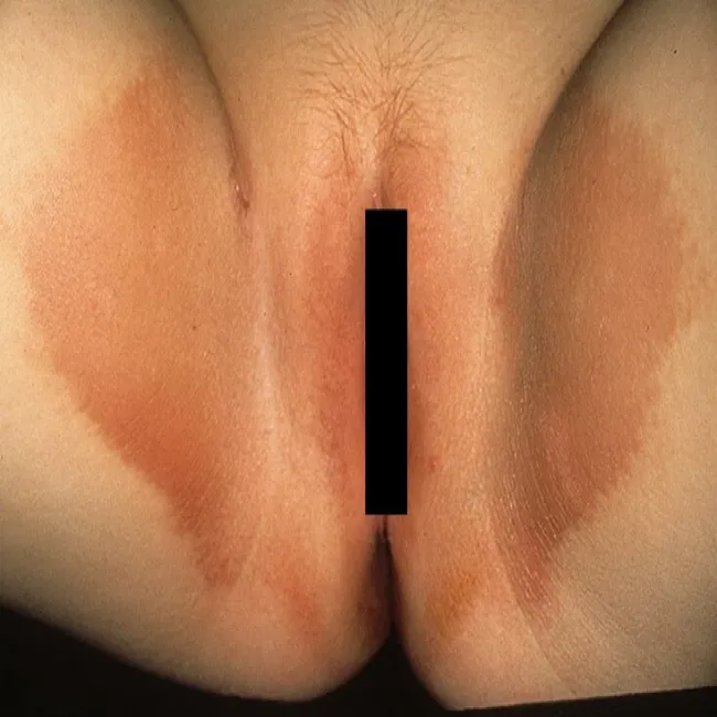 Czerwone plamy w pachwinach erythrasma 