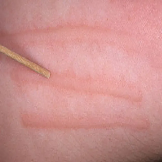 Czerwone pręgi po drapaniu