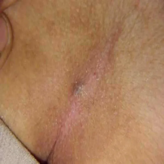 Czerwony pasek między pośladkami torbiel pilonidalna