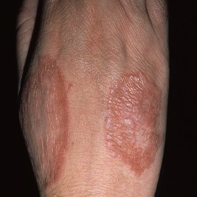 Czerwony rumień na dłoni ziarniniak obrączkowaty 