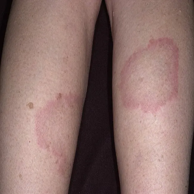 Czerwony rumień na nodze ziarniniak obrączkowaty 