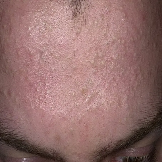 Czoło zaskórniki zamknięte