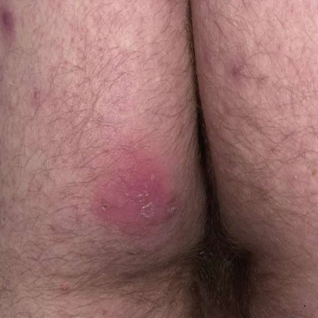 Czyrak na pośladku zdjęcie