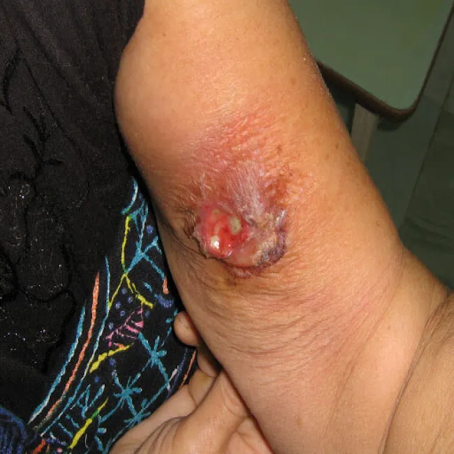 Czyrak nieestetyczny wrzód na ręce