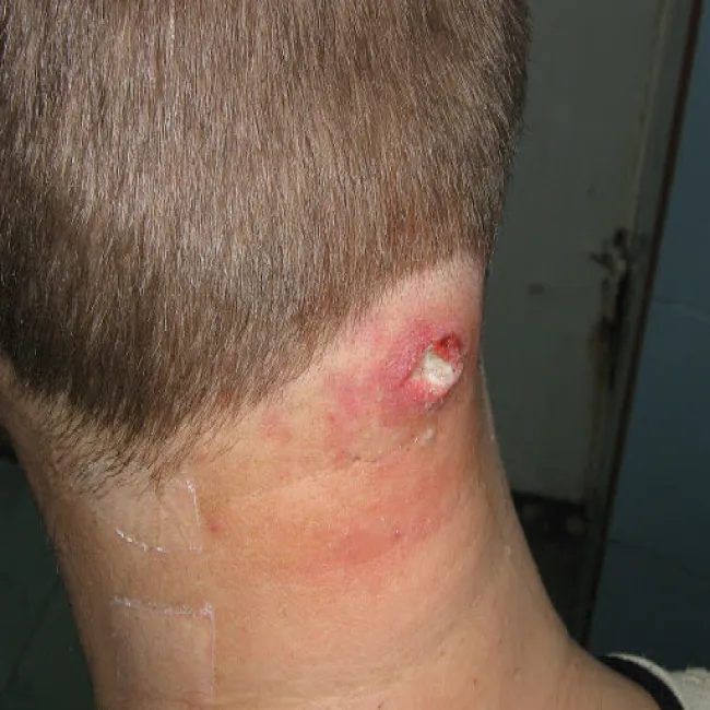 Czyrak u mężczyzny na karku