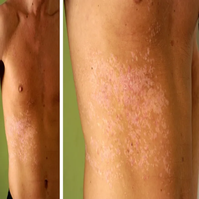 Darier-White disease