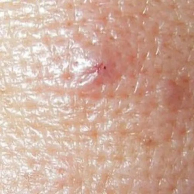 Demodex brevis nużeniec