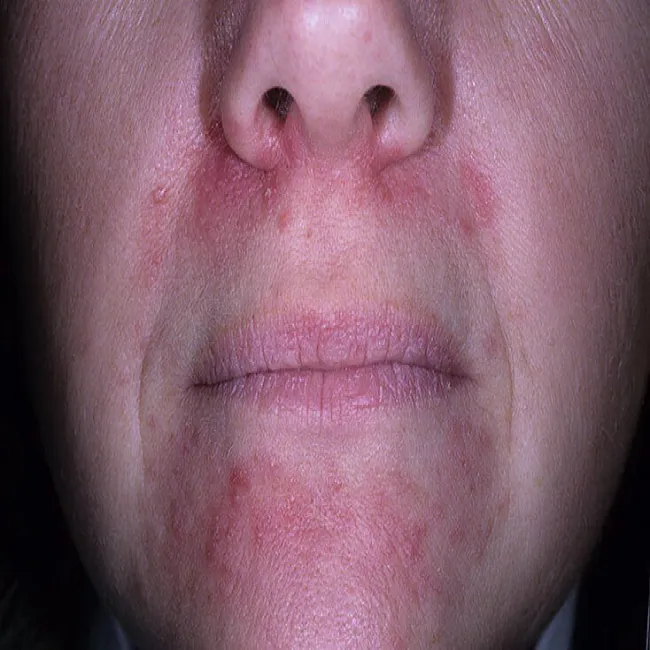 Dermatoza okołoustna u kobiety