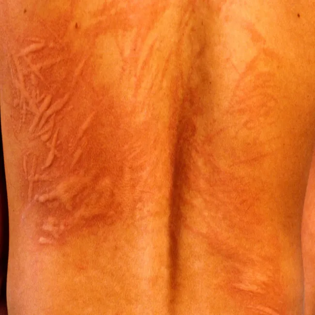 Dermografizm na tle nerwowym