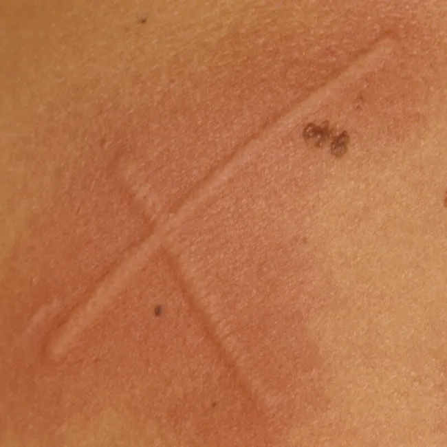 Dermografizm pokrzywkowy