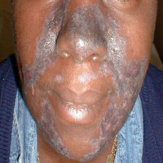 Discoid lupus erythematosus