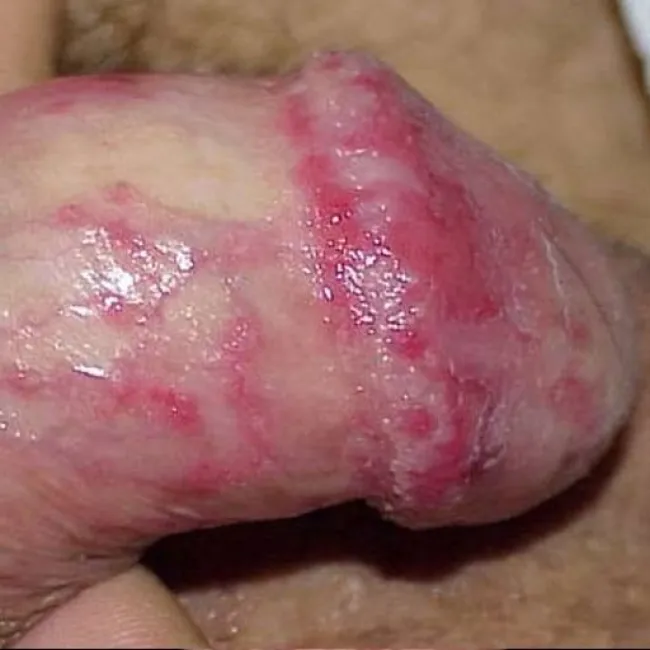 Drożdżakowe zapalenie żołędzi i napletka