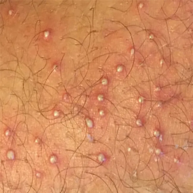 Duże ropne krosty na skórze