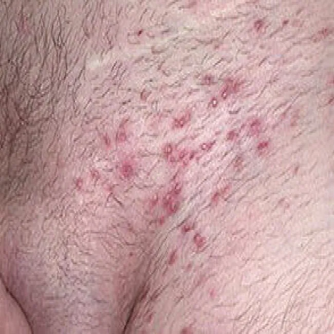 Duże ropne krosty w okolicach intymnych