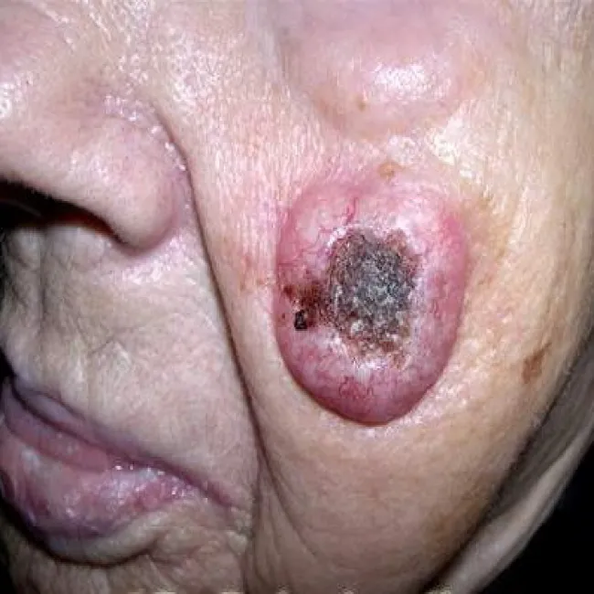 Duży guz na poliku rogowiak kolczystokomórkowy skóry 