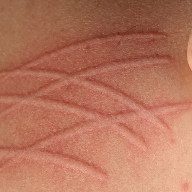 Dziwne choroby skóry dermografizm 