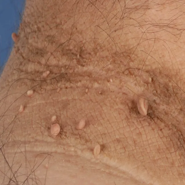 Dzyndzelki na skórze choroba włókniaki