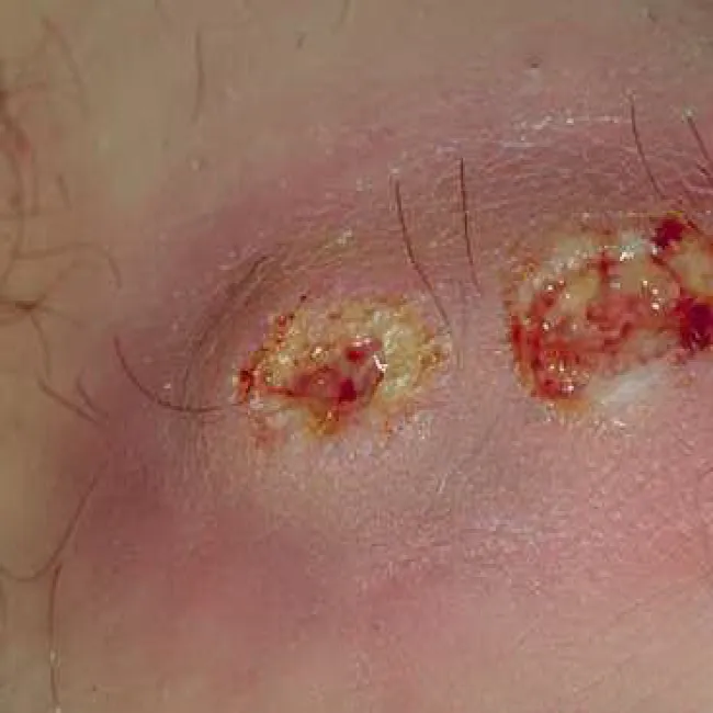 Ecthyma paciorkowiec ropotwórczy 