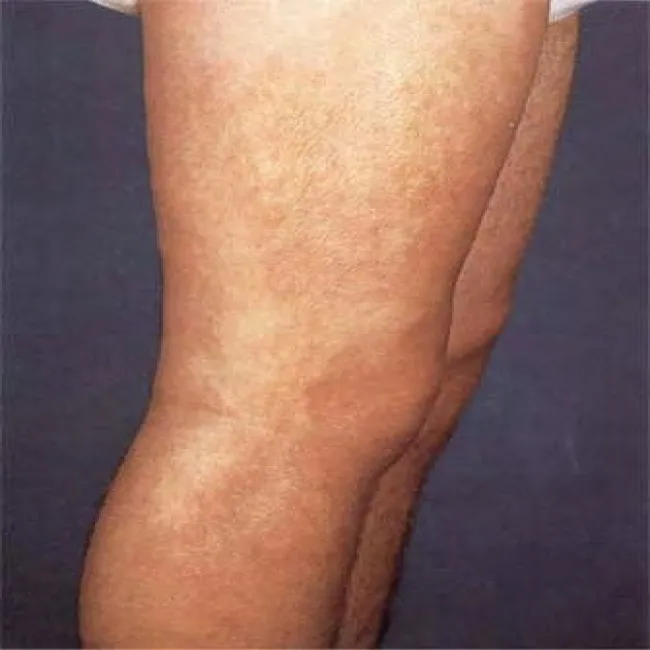 Eozynofilowe zapalenie powięzi