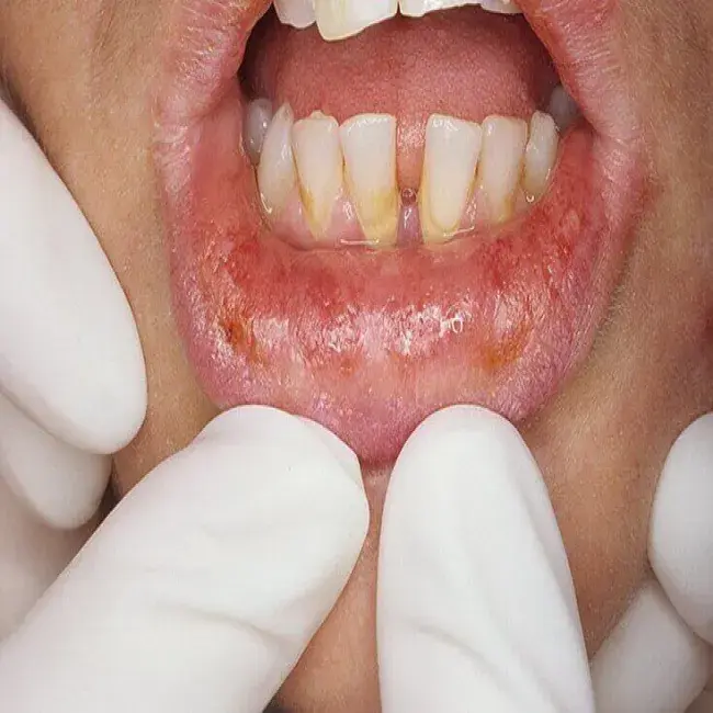 Erythema multiforme na ustach