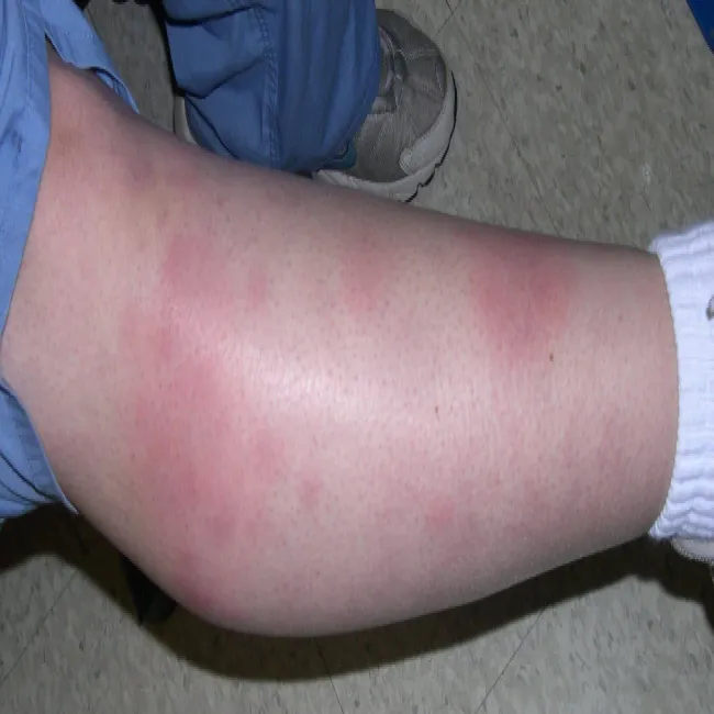 Erythema nodosum