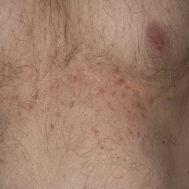 Gęsta wysypka jaskrawoczerwonych grudek na skórze choroba Grovena