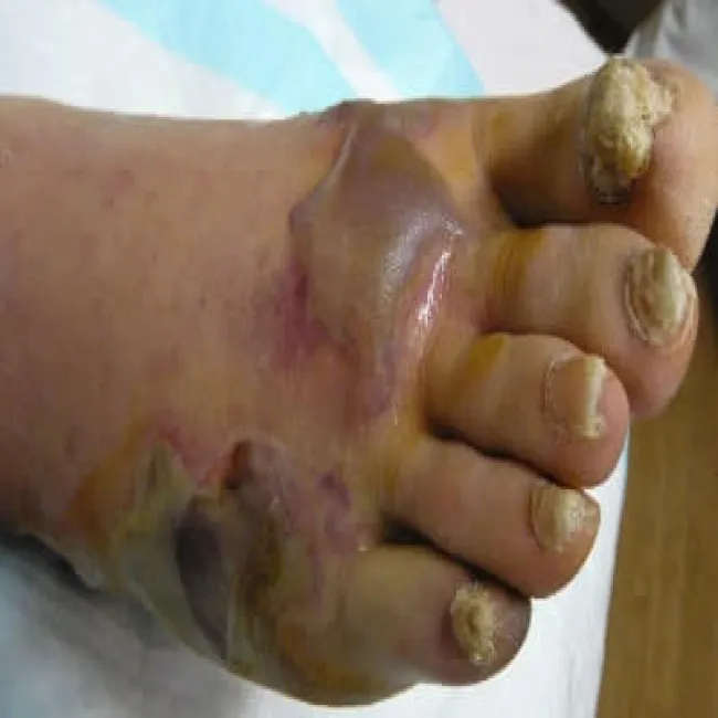 Gangrena mokra stopy