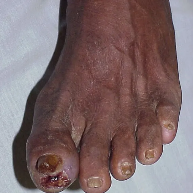 Gangrena wilgotna na stopie