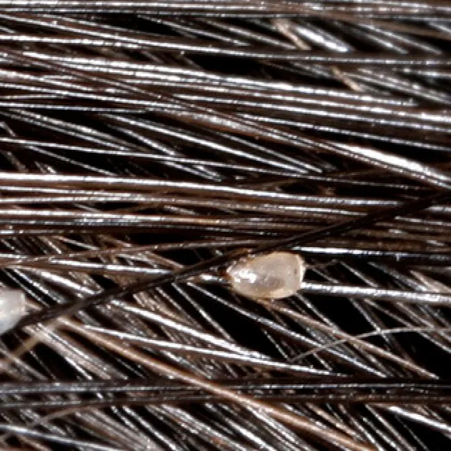 Gnida na włosach zdjęcie