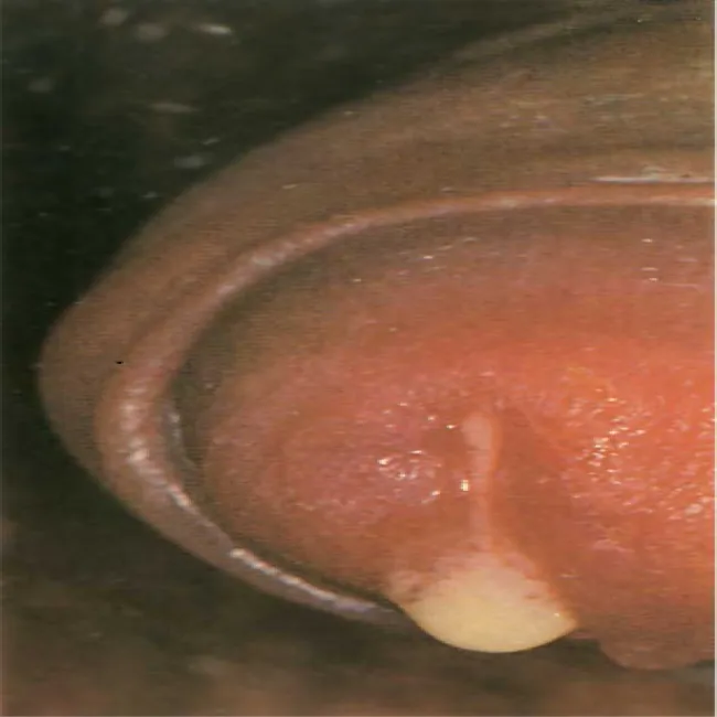 Gonokokowe rzeżączkowe zapalenie dróg moczowo-płciowych