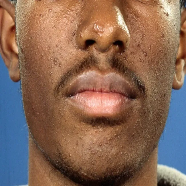 Gruczolak łojowy na twarzy