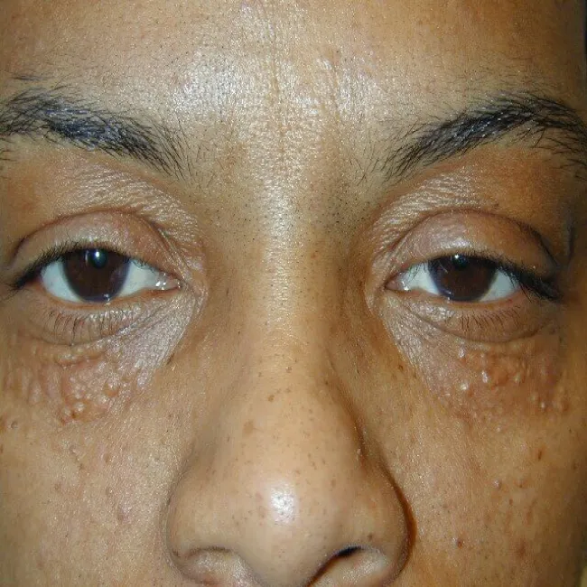 Gruczolaki potowe syringoma na twarzy