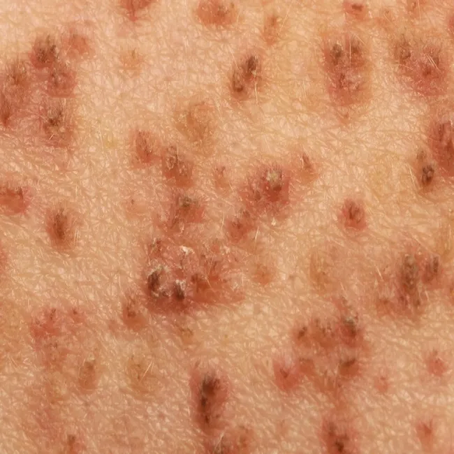 Grudki brązowe na skórze choroba Dariera