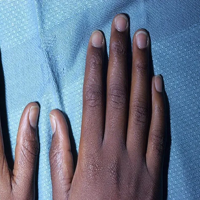 Grudki na dłoniach palcach liszaj lsniący