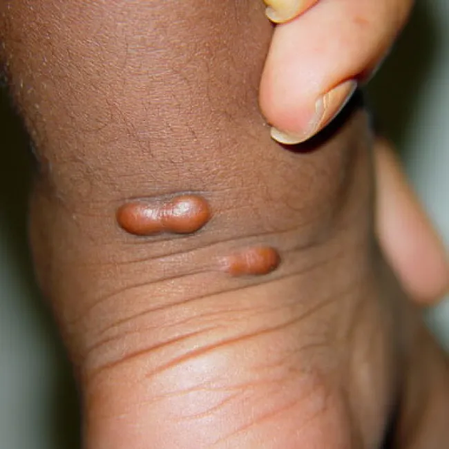 Grudki na pięcie kępki żółte guzkowe 