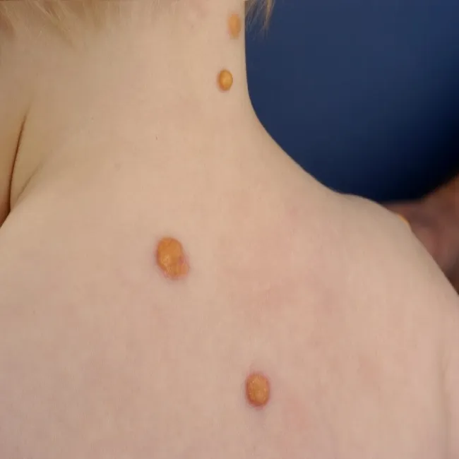 Grudki na plecach u dziecka żółtakoziarniniakowatość młodzieńcza